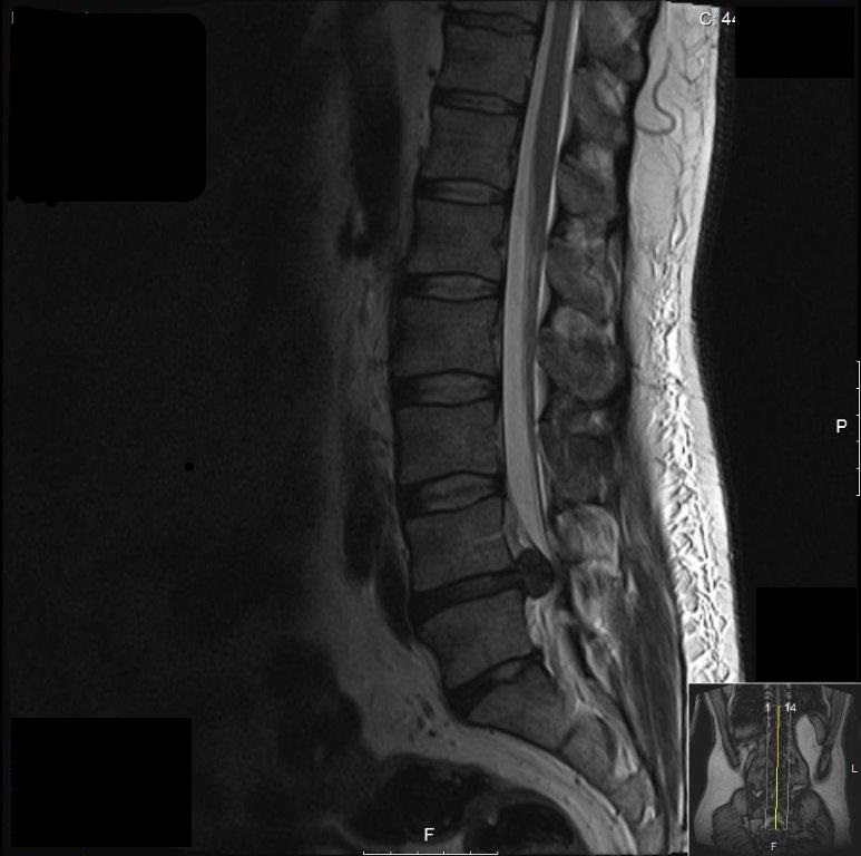 MRI of prolapsed disc in a man with chronic sciatica