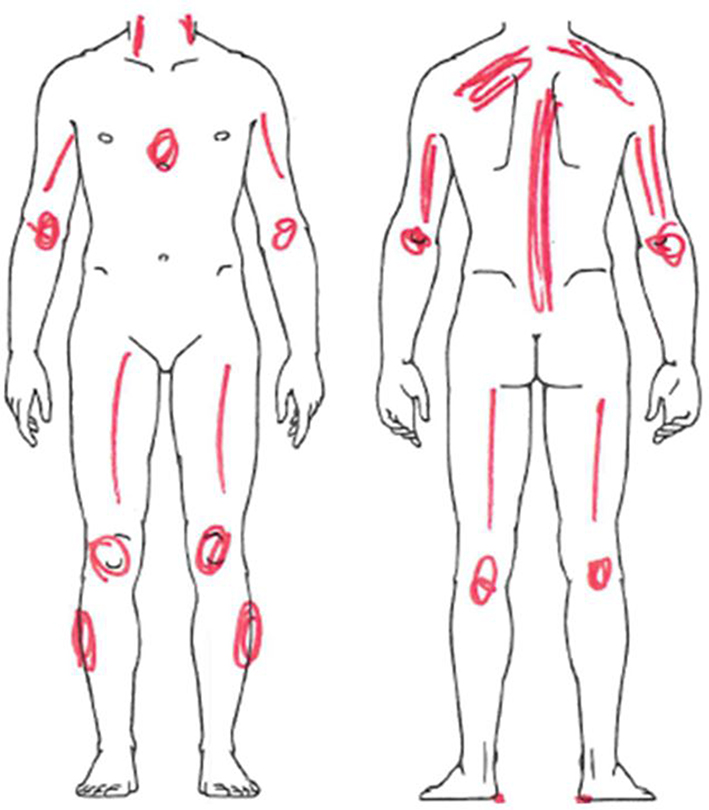 diagram of distribution of pain in fibromyalgia patient in Belfast