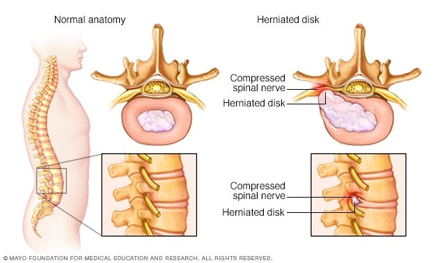 diagram of sciatica or chronic back pain