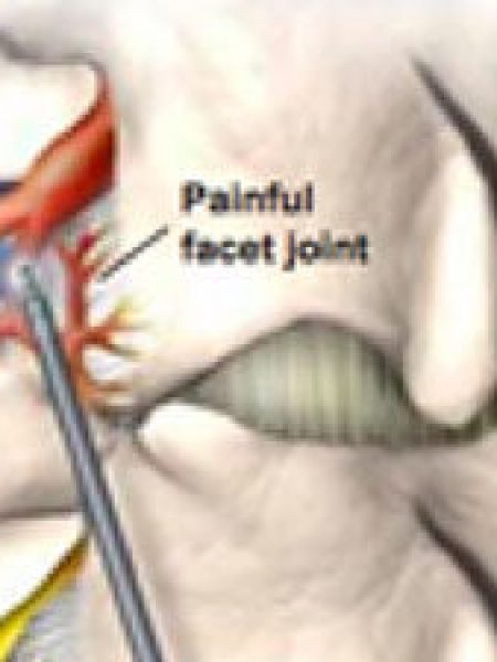 Radiofrequency ablation as a treatment for chronic pain